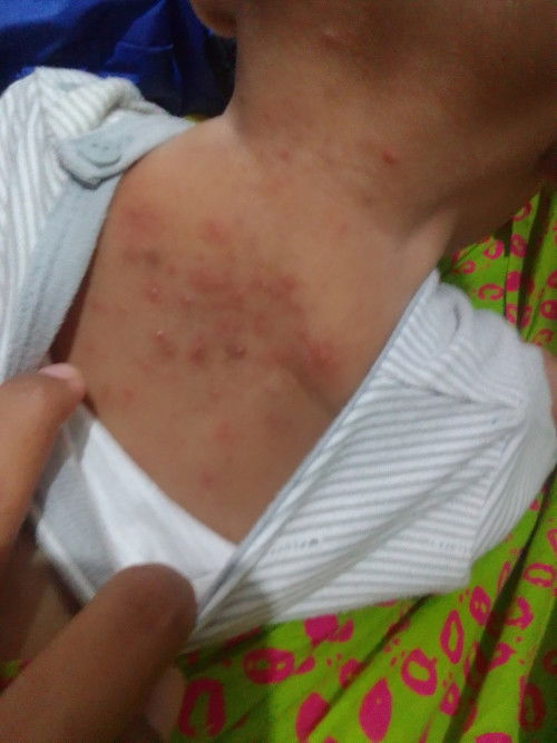 Mau tanya Bun apa ada yg sama kaya ank saya udh pke salep sma talek tetep aja blom ilang"