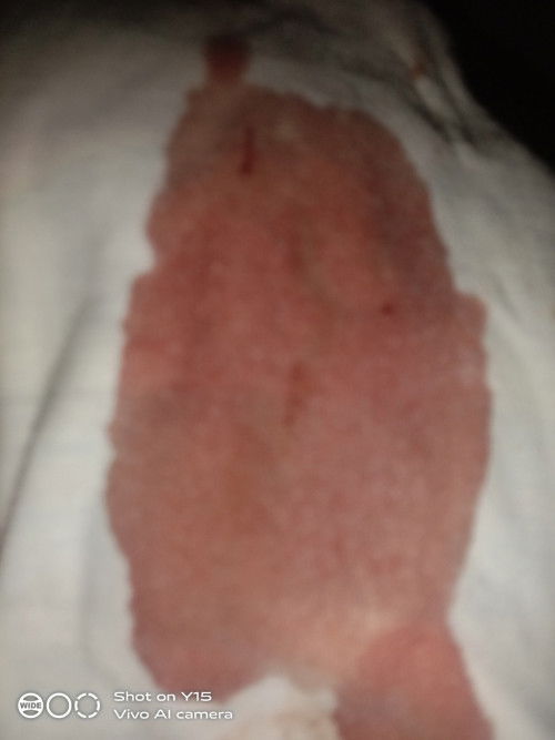 Spotting to bleeding