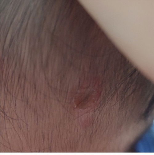 Luka seperti Melepuh pada tubuh bayi