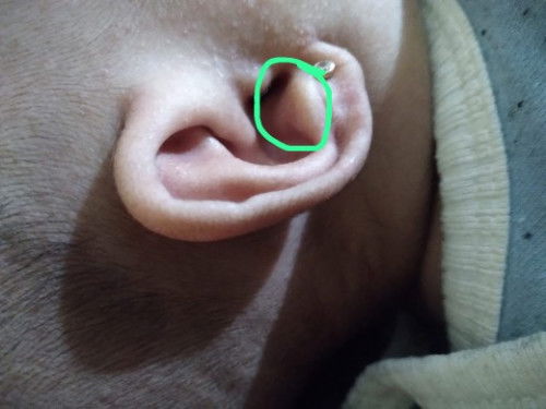 Daun telinga anak beda sebelah