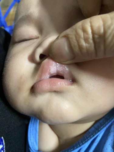 Lưỡi miệng mọc trắng