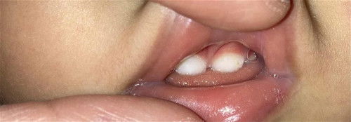 Stain/Spot sa ipin ni baby