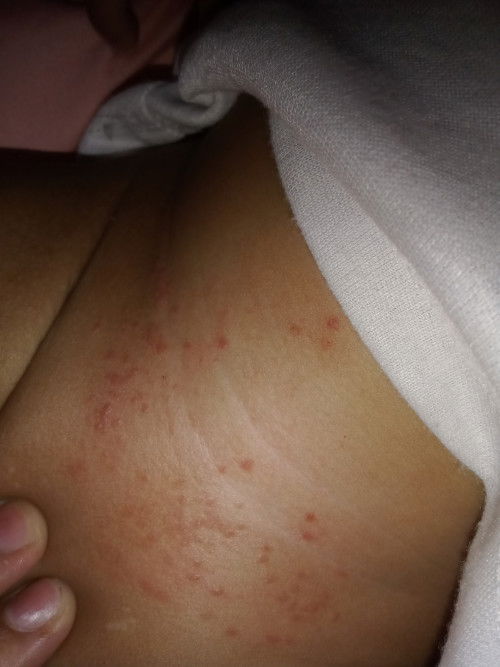 Gatal pada pantat bayi