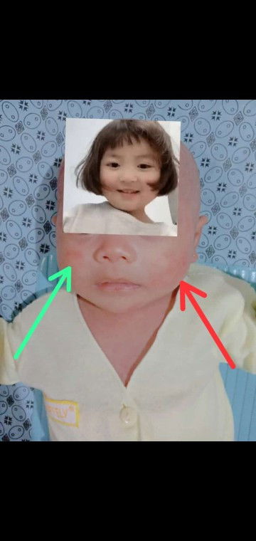 Pipi . tangan . paha . leher . merah2 . macam bruntusan