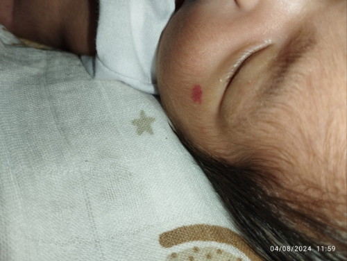 Ano po kaya itong nasa mukha ng baby ko. Lumalaki po sya.