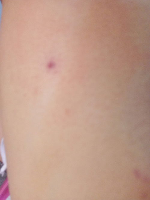 แตนต่อยตัวใหญ่สีเหลืองจะส่งผลต่อลูกไหม