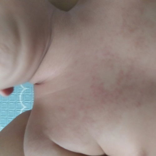 Kulit bayi kering kasar merah2 kenapa ya, sembuhinnya pake apa?