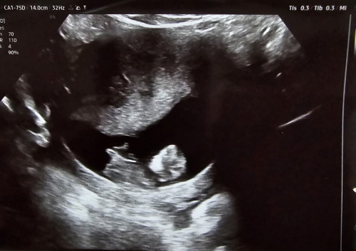 Girl or boy?