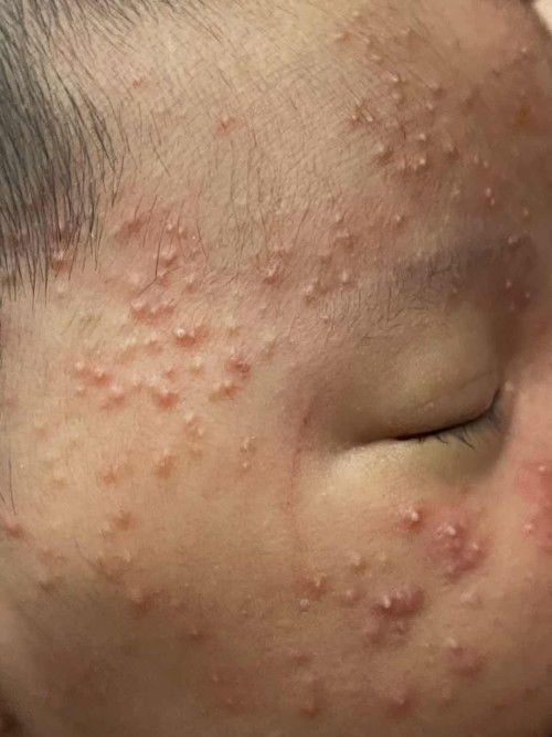 Ruam normal atau tak