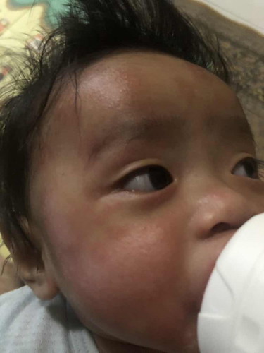 Kulit anak merah2