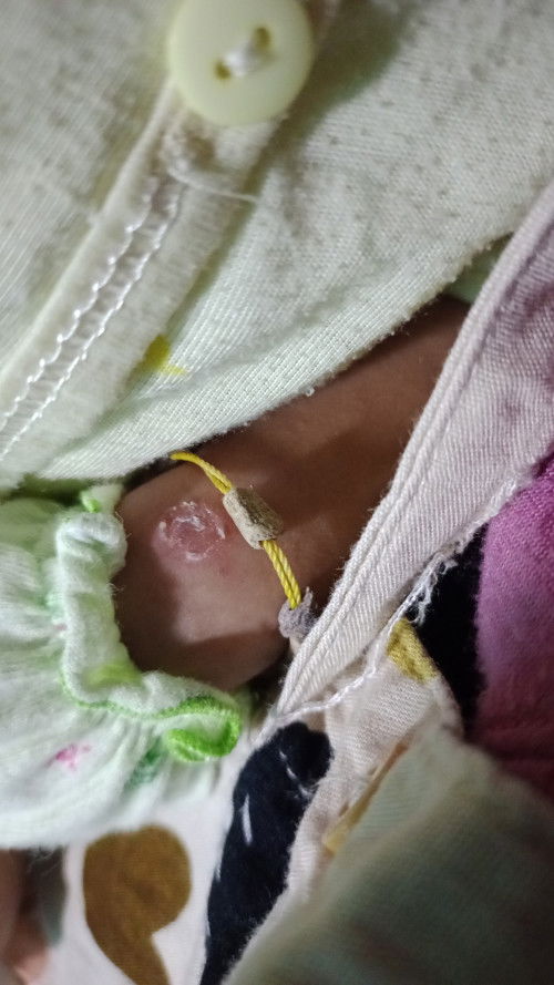 Kulit seperti melepuh