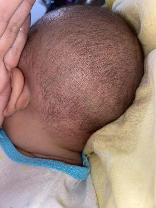 Merah2 dikepala belakang dan leher bayi