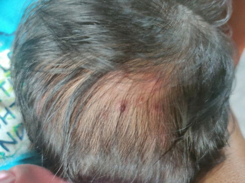 Parang pimple na may nana sa ulo at kamay ni baby