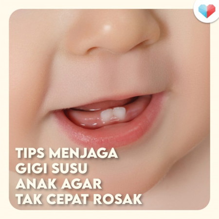 Tips Jaga Gigi Susu Bayi Agar Tidak Cepat Rosak