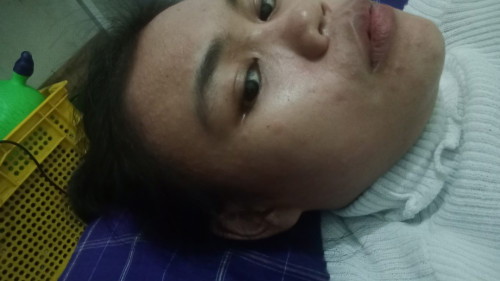 Hormon atau alergi