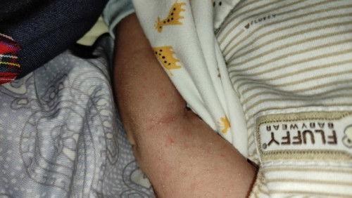 Bruntusan pada newborn