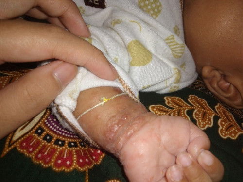 Bintik merah kaya kutu air