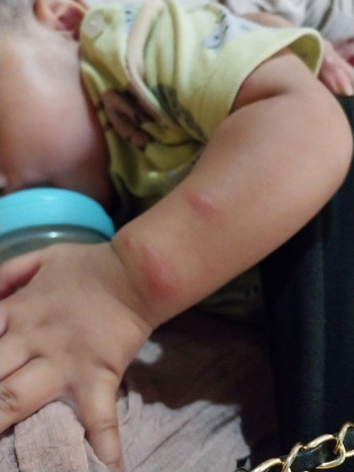 tangan & kaki bentol² gede