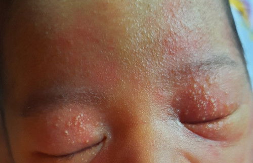 Newborn usia 4 hari ruam dimata