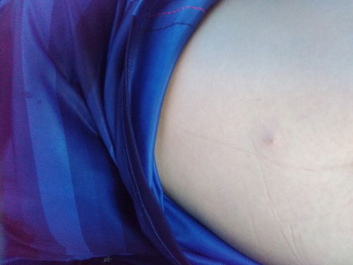 ตุ้มแดงๆขึ้นบนหน้าท้องมีอาการเจ็บๆเหมือน​จะ​เป็น​หนองด้วย สาเหตุ​เกิดจากอะไรค่ะ