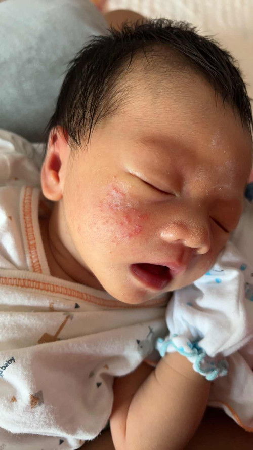 ใช่ผดร้อนไหมคะมีวิธีรักษาไหม