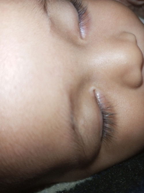 Gatal di sekitar kelopak dan bawah mata