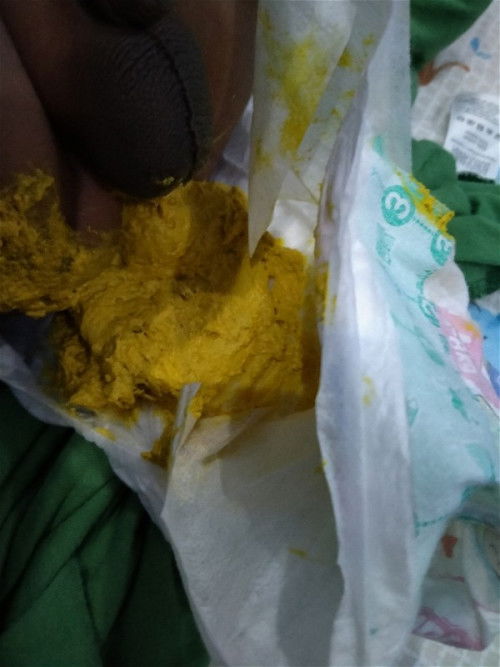 Bayi 1 bulan 22 hari  asi dan sufor bab lengket dan berbau