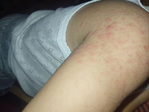 Flu singapur atau bukan?