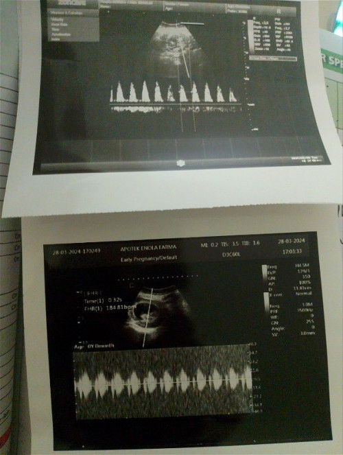 Hamil diluar kandungan
