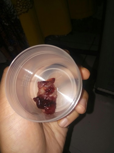 Keguguran di usia kehamilan 7 minggu