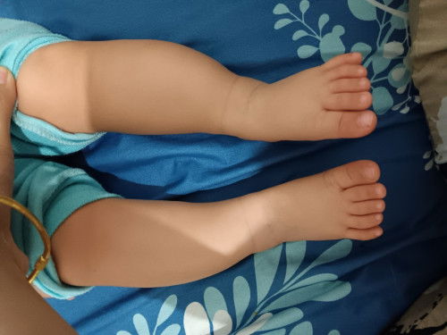 Kaki bayi bengkok