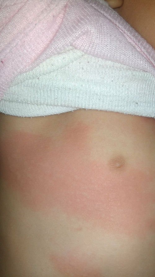 Badan tetiba merah dan bentol