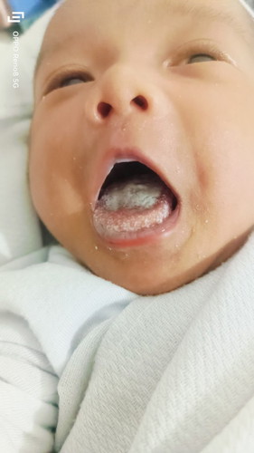 white spot sa mouth ni newborn dumadami na kasi nag alala ako bka lumala anu po gamot dito
