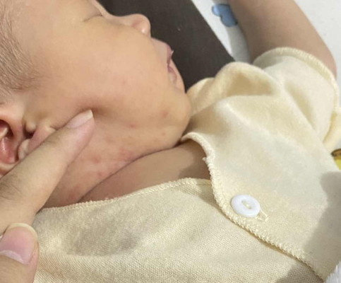 ruam dileher bayi 2minggu pakai apa ya?