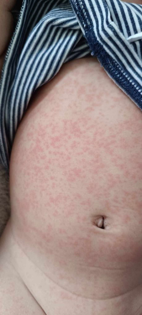 ผื่นแดงเด็กลามไปตัวตัว