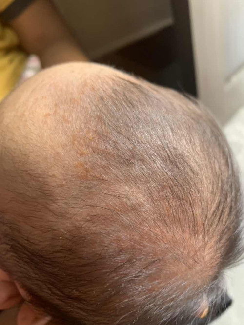 Ruam di kepala newborn