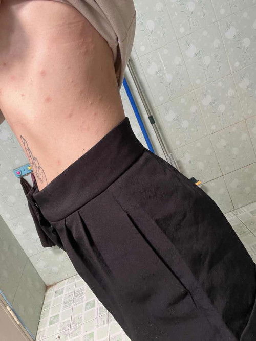 ผื่นแดงขึ้นแต่ไม่คัน