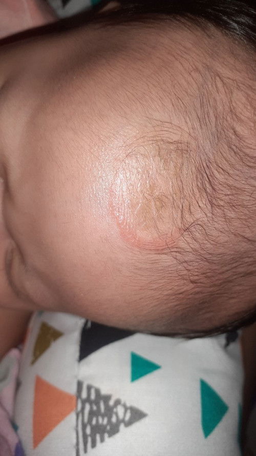 Tertular penyakit kulit