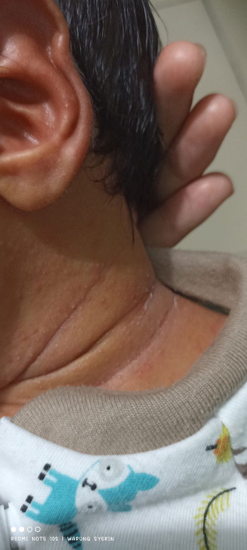 Kali aja ada yg tau pake apa yaa bun, ngeliatnya gak tega bgt bayi 2minggu keluar beruntusan