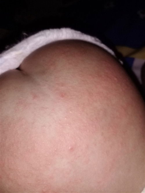 Ruam popok atau biang keringat