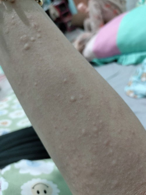 Biduran setelah melahirkan