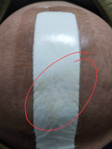 สอบถามแม่ๆผ่าคลอดหน่อยค่ะ