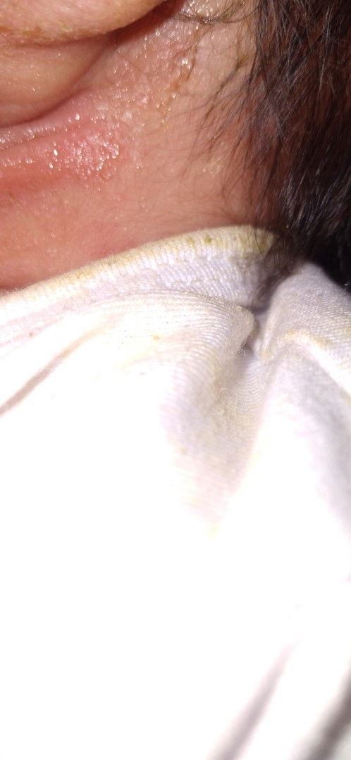 Nagtutubig sa likod ng taenga