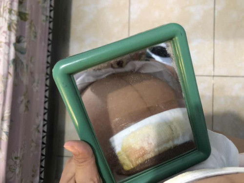 Habis lahiran caesar