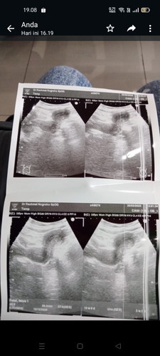 SDH USG tp blm kelihatan.udh 2 bulan nda haid . Tp diksh vitamin disuruh balik 1 bulan lg