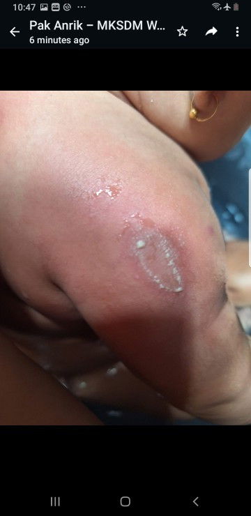 Merah merah di kulit