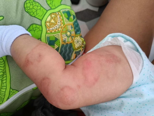 Rashes?????