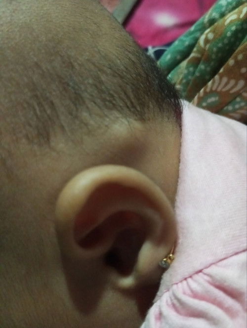 Benjolan dibelakang telinga