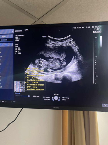 Gender baby