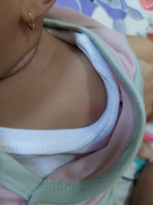 bayi usia 2bln11hr after minum sufor ada sdkit bentol merah dipipi